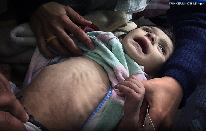 시리아 시리아내전 알레포 알레포어린이 어린이 영양실조 폭탄 전쟁 폭격 유니세프 난민